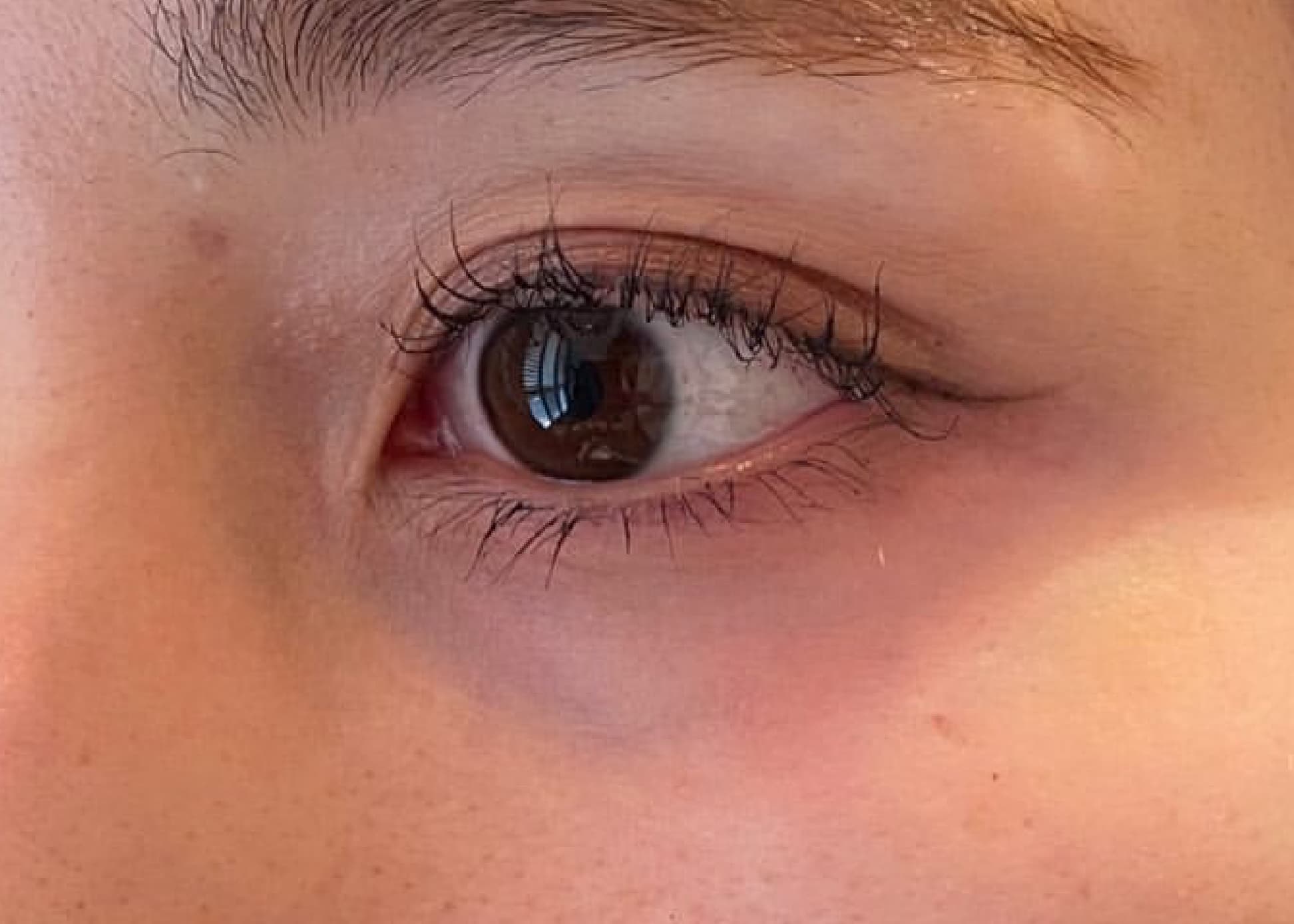 Baby Collagen Injection Before
