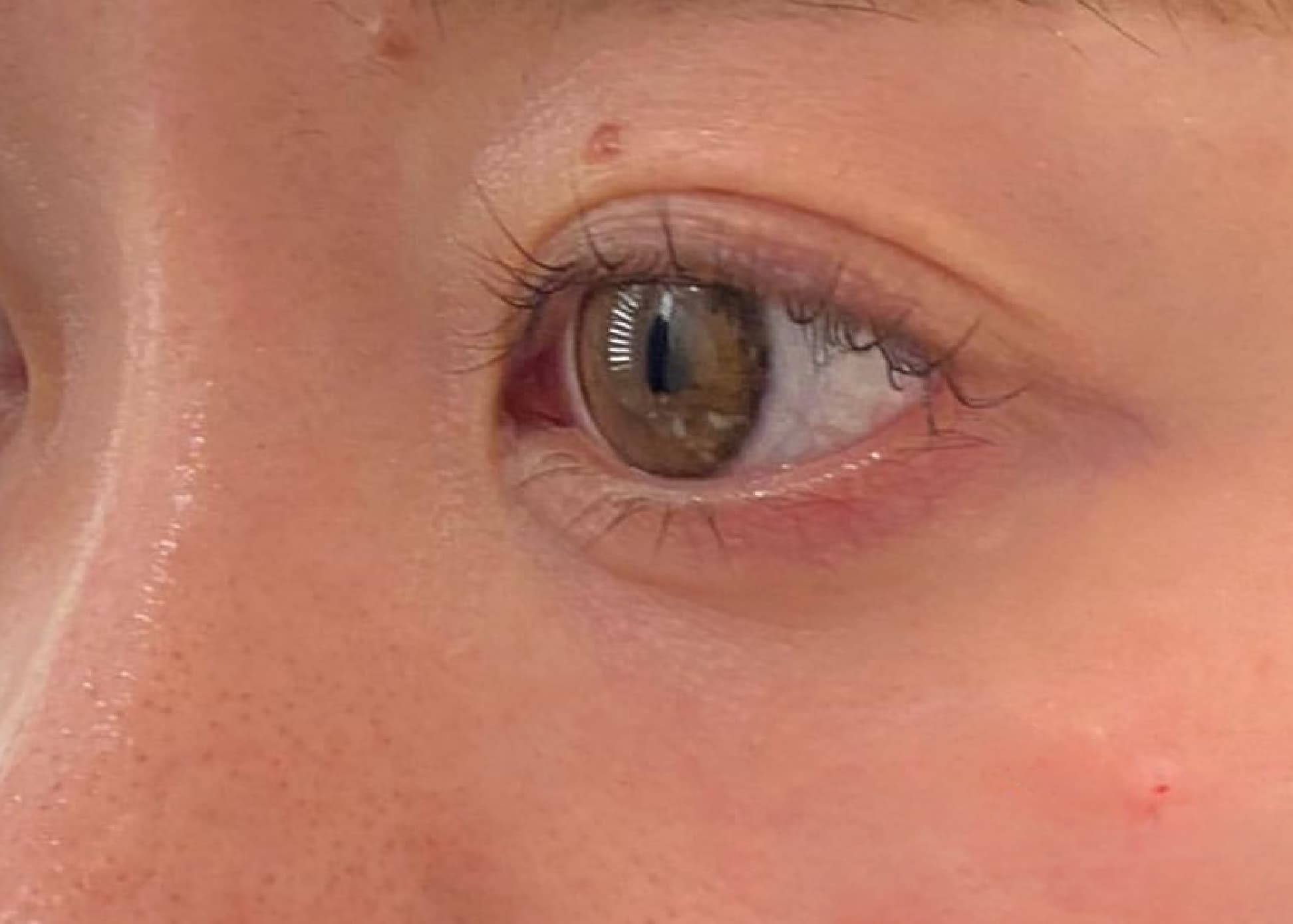 Baby Collagen Injection After