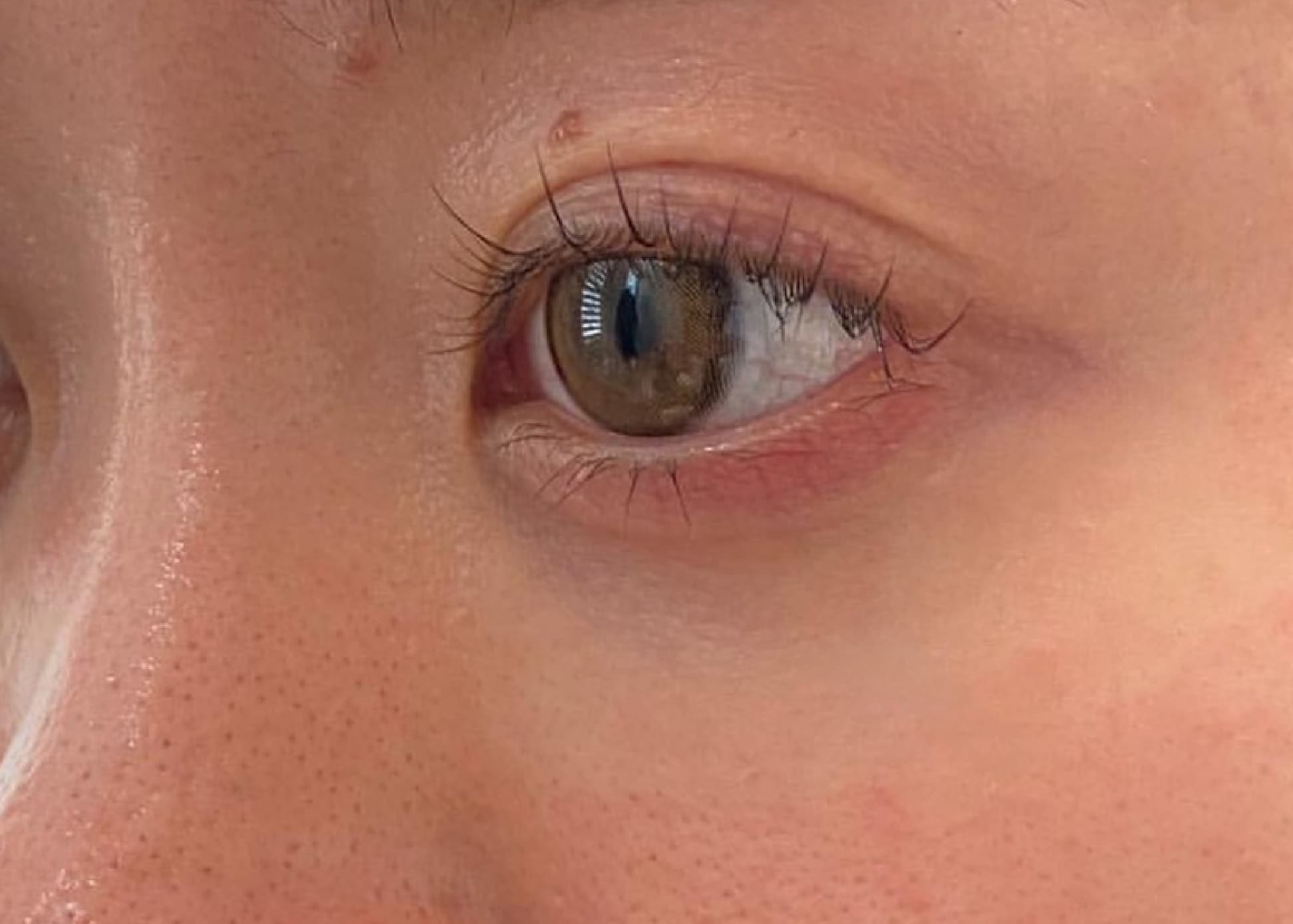 Baby Collagen Injection Before