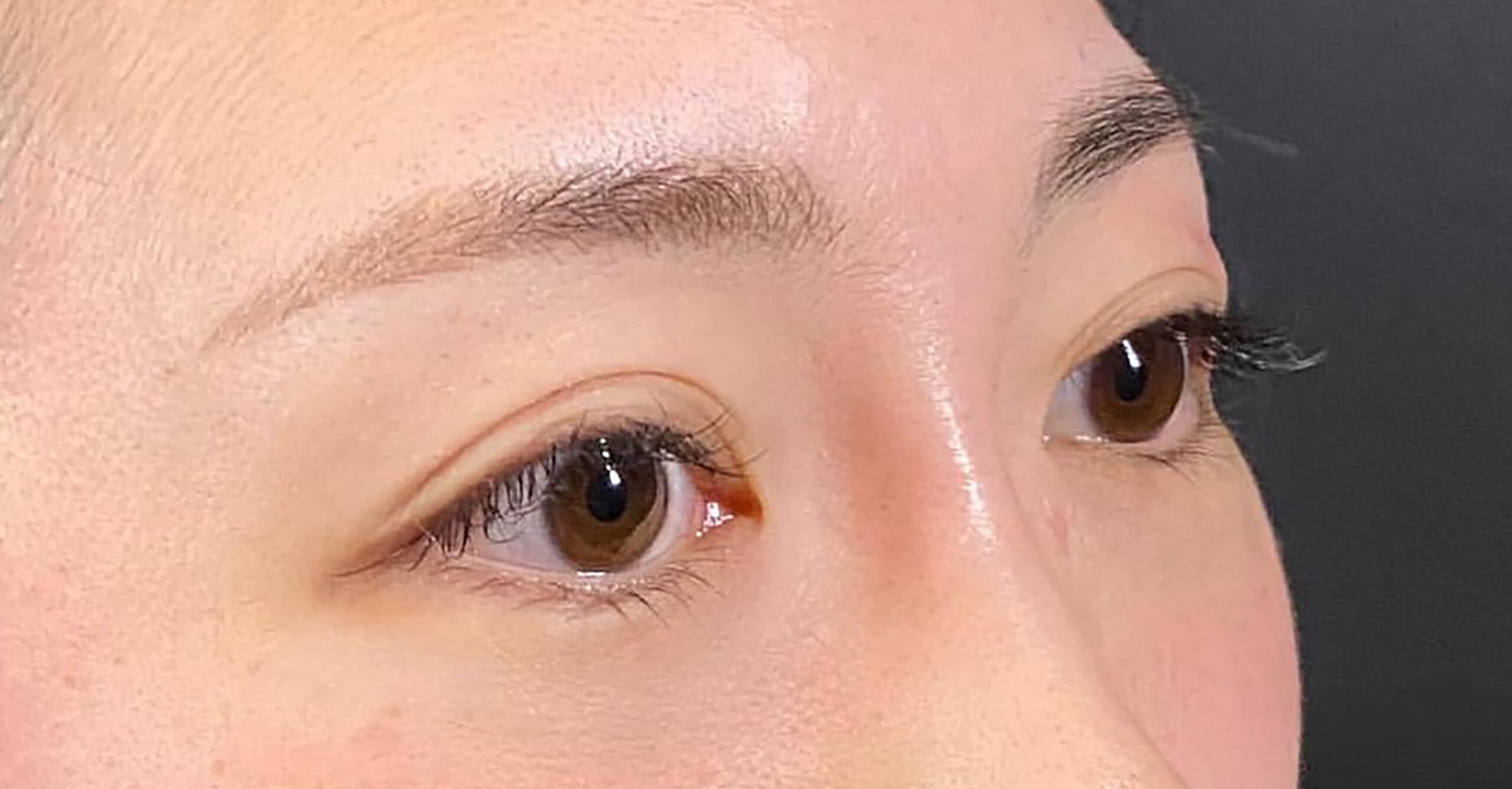 Nose Bridge Hyaluronic Acid After