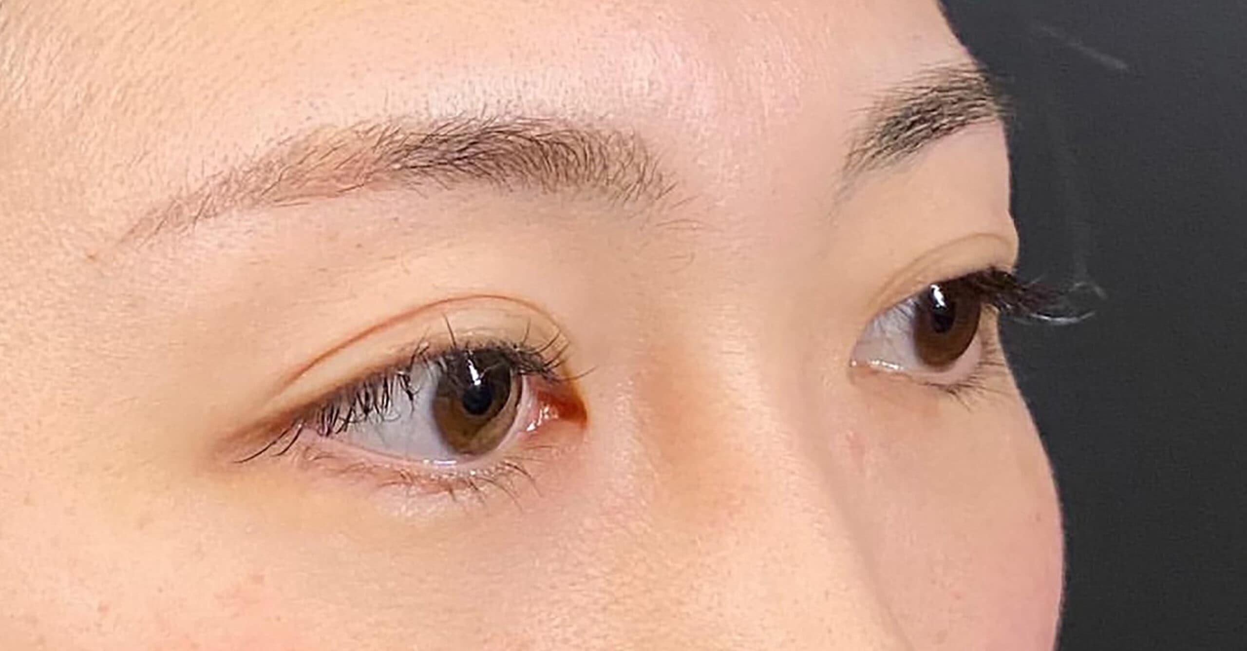Nose Bridge Hyaluronic Acid Before