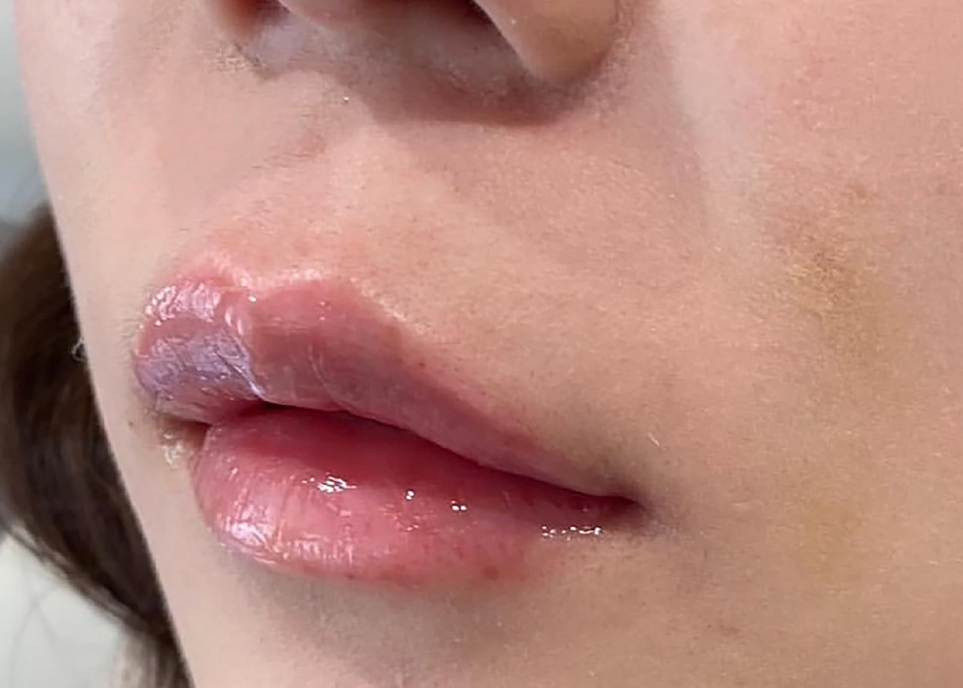 Philtrum Shortening (Botox + Filler) After