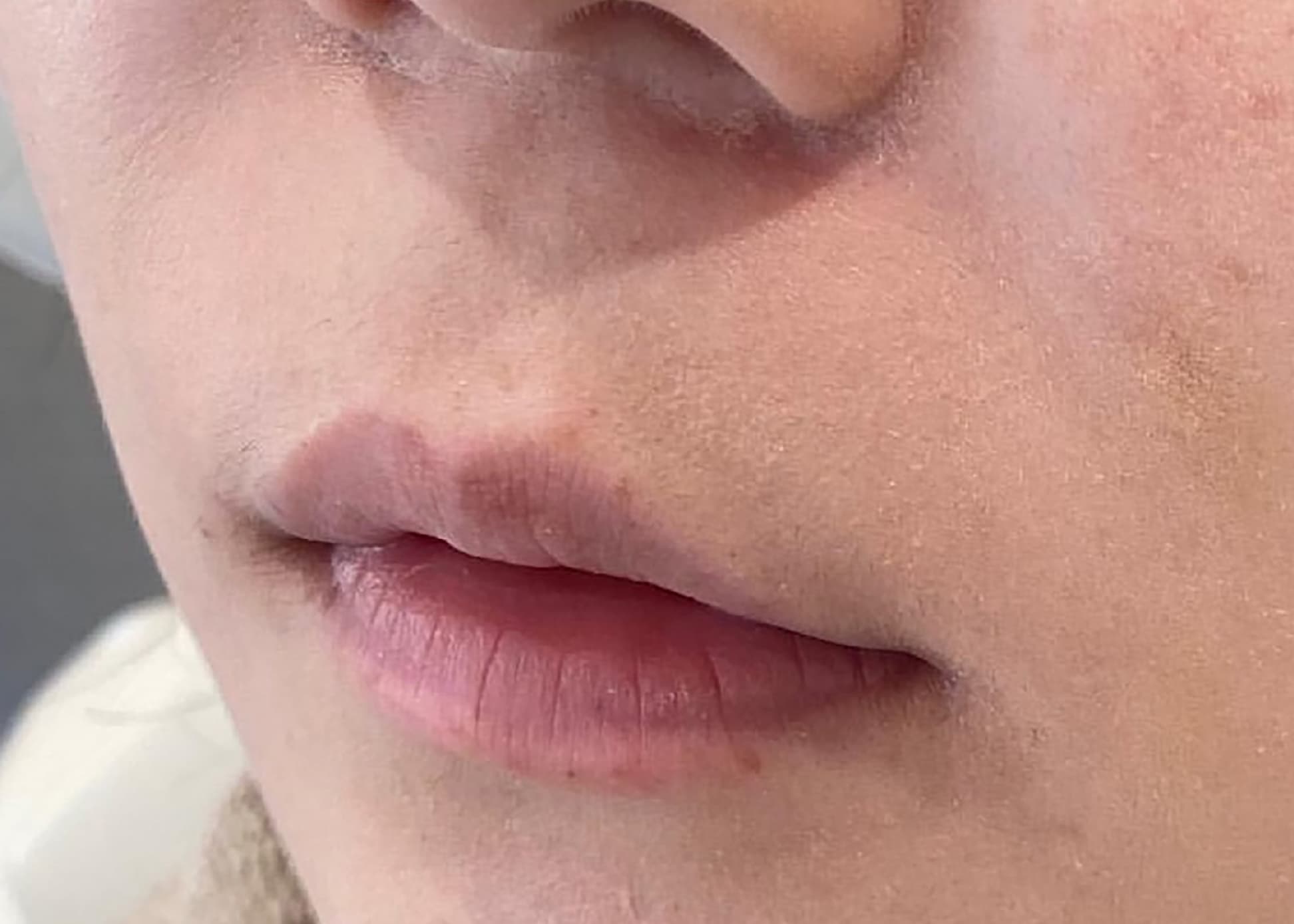 Philtrum Shortening (Botox + Filler) Before