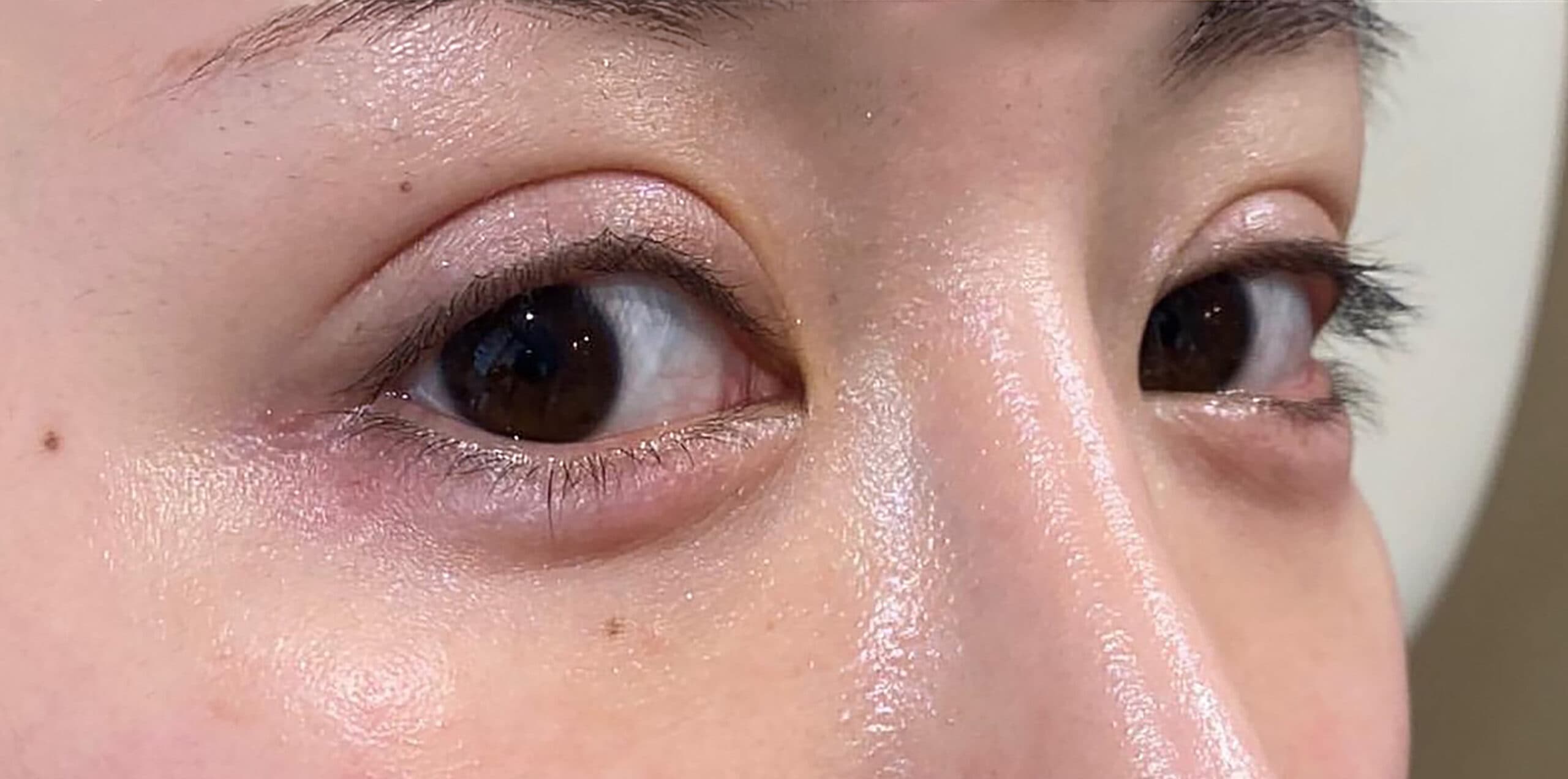 Tear Trough Hyaluronic Acid After