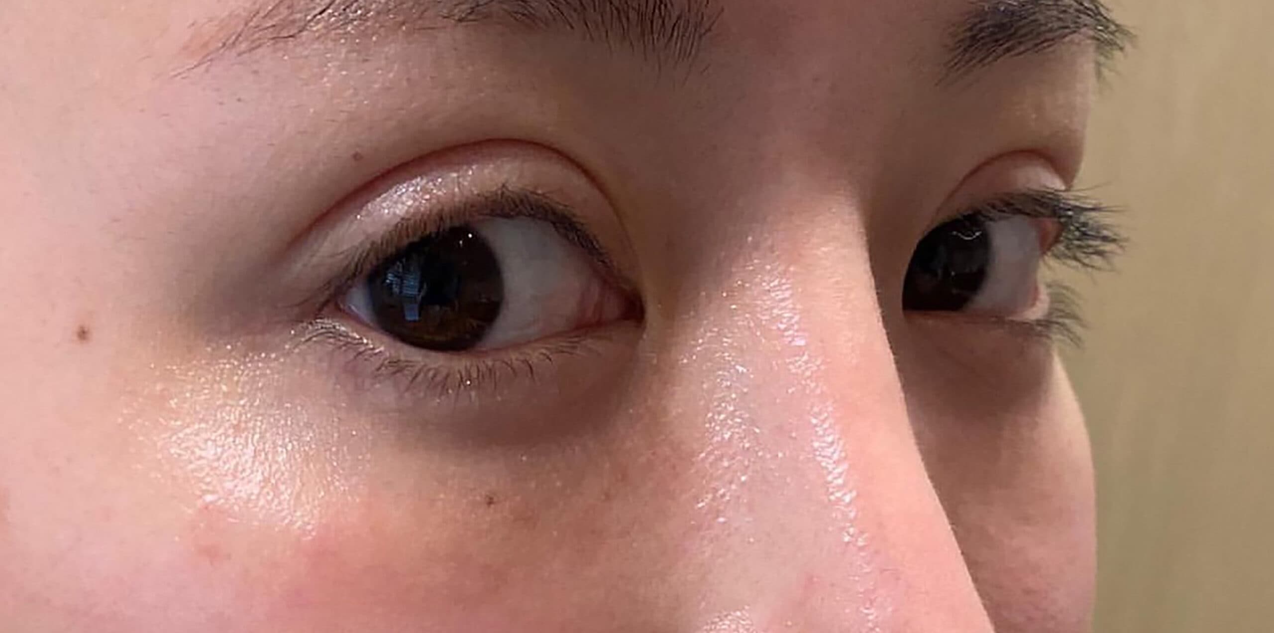 Tear Trough Hyaluronic Acid Before