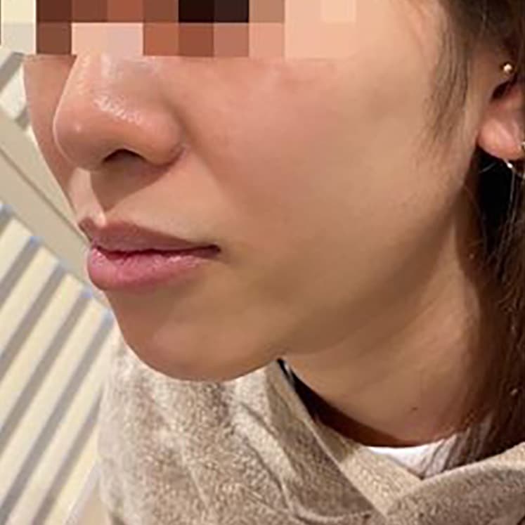 Hyaluronic Acid Before