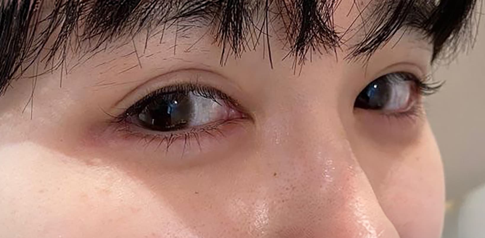 Tear Trough Hyaluronic Acid After