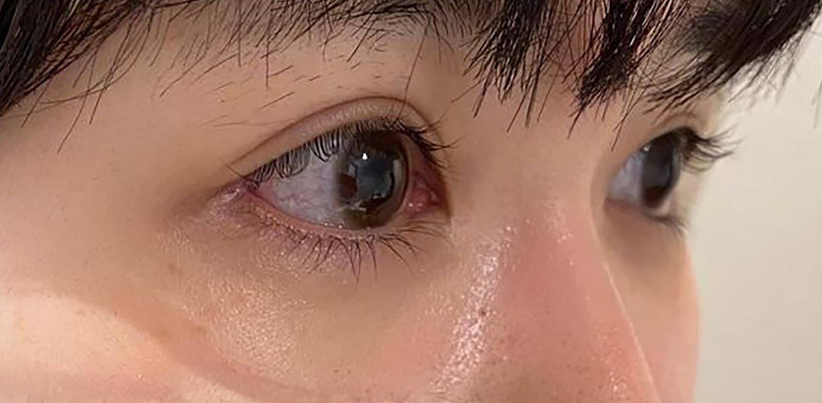 Tear Trough Hyaluronic Acid Before