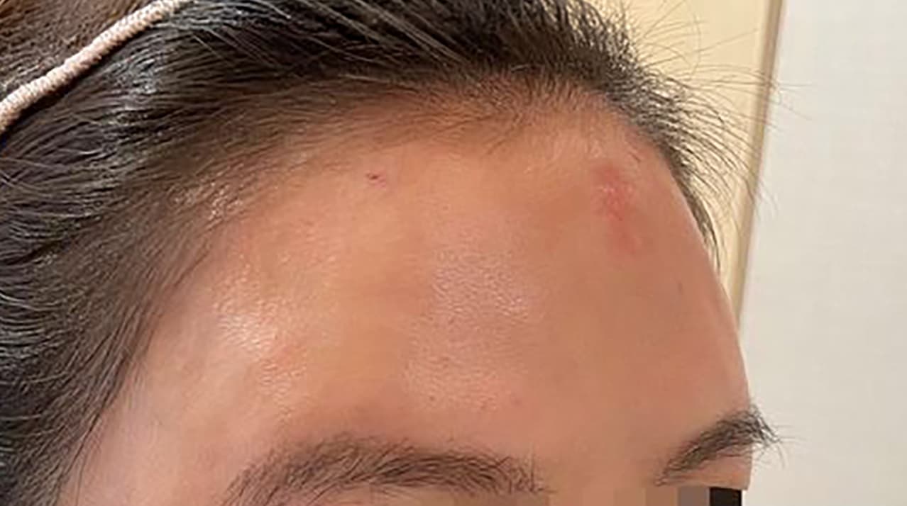 Forehead Hyaluronic Acid After