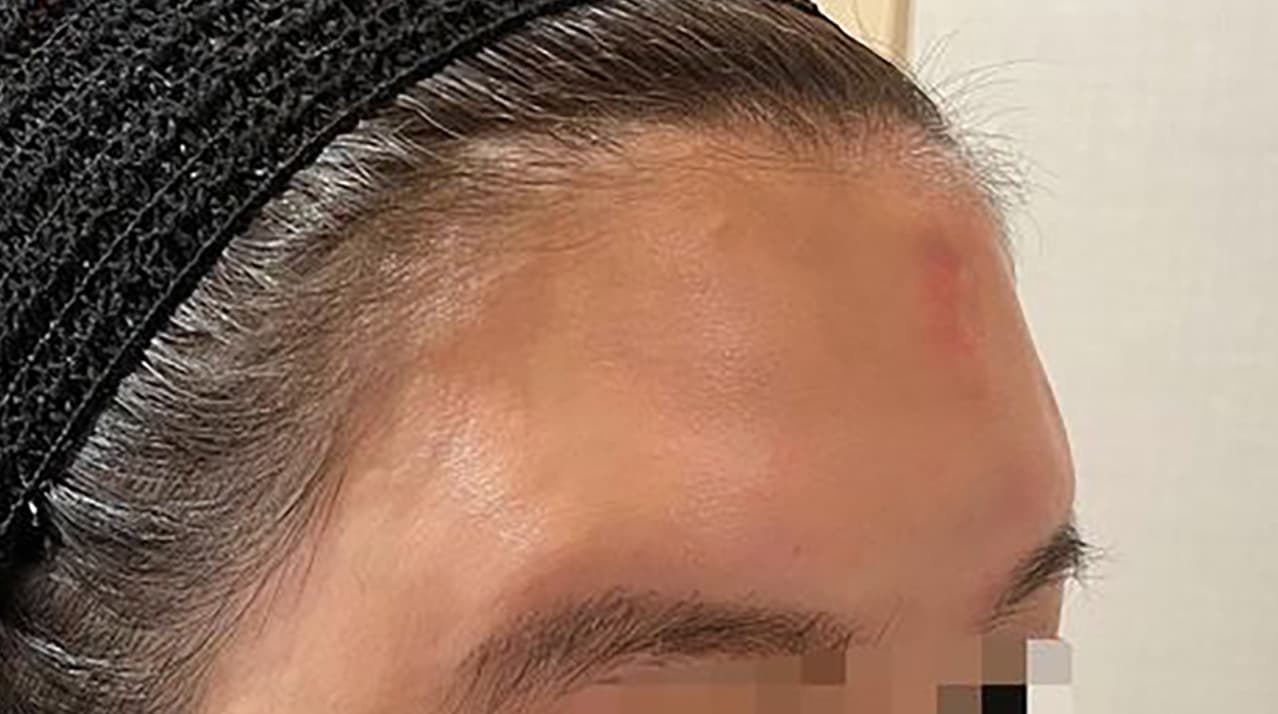 Forehead Hyaluronic Acid Before