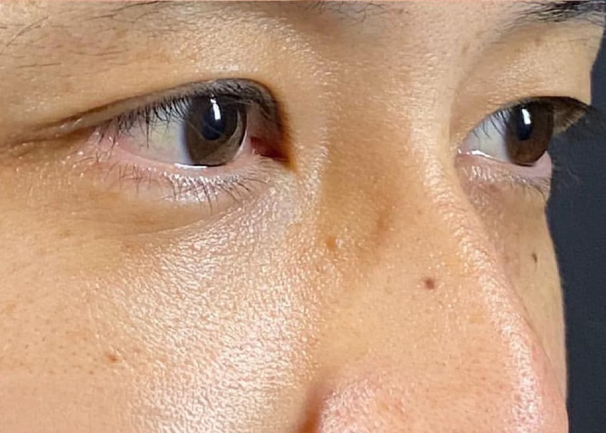 Lower Eyelid Fat Removal Surgery After