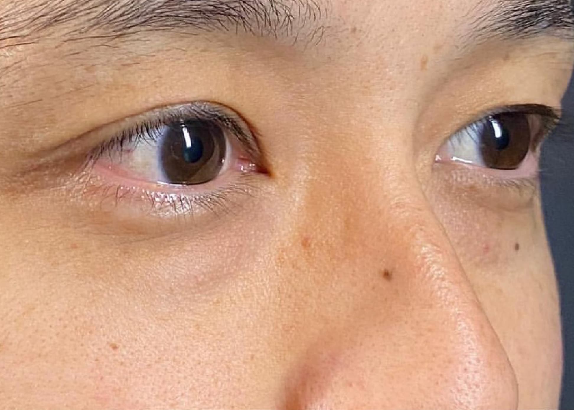 Lower Eyelid Fat Removal Surgery Before