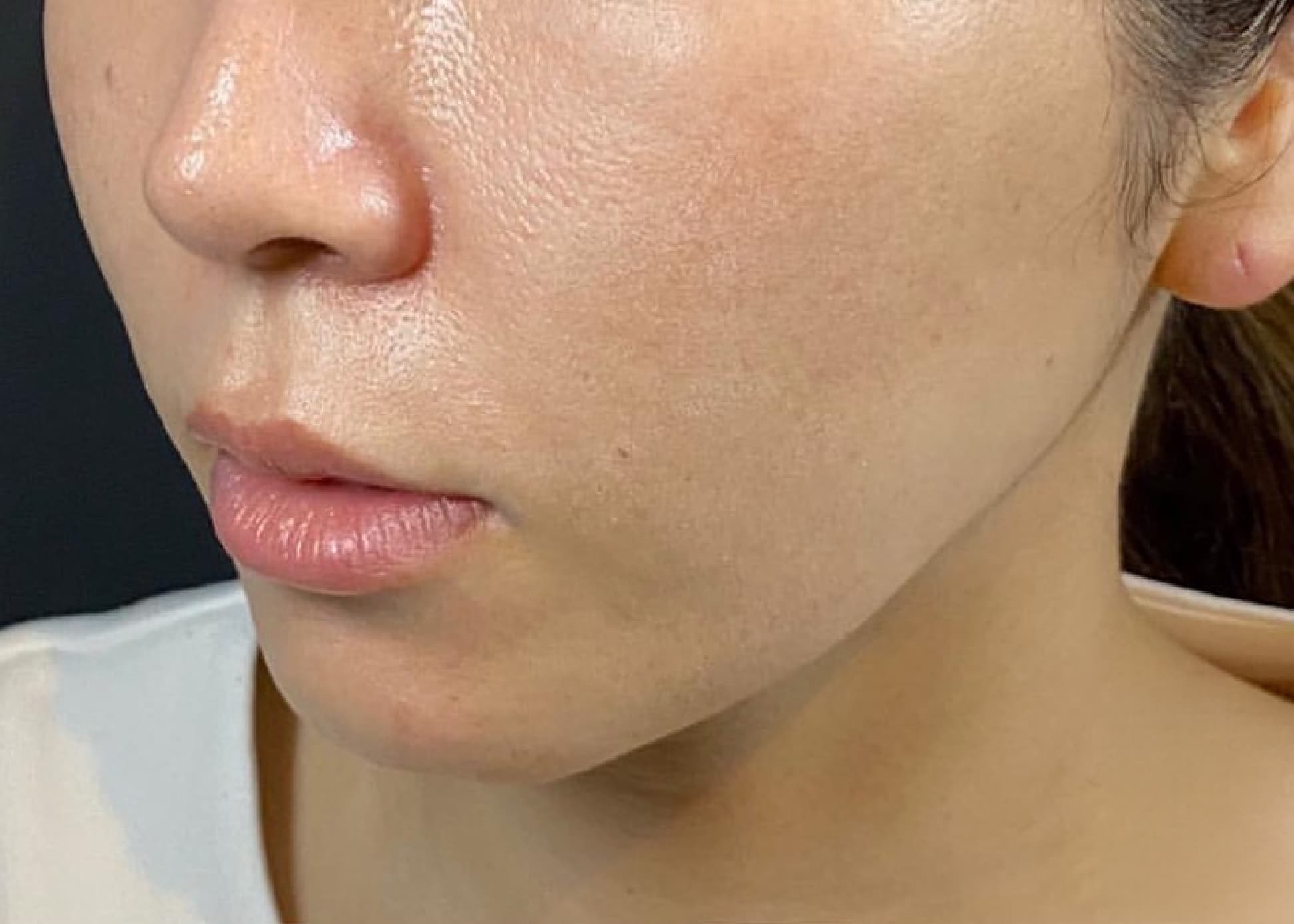 Mix Thread Lift After