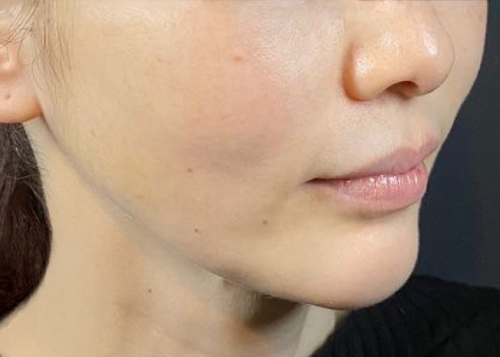 Mix Thread Lift After