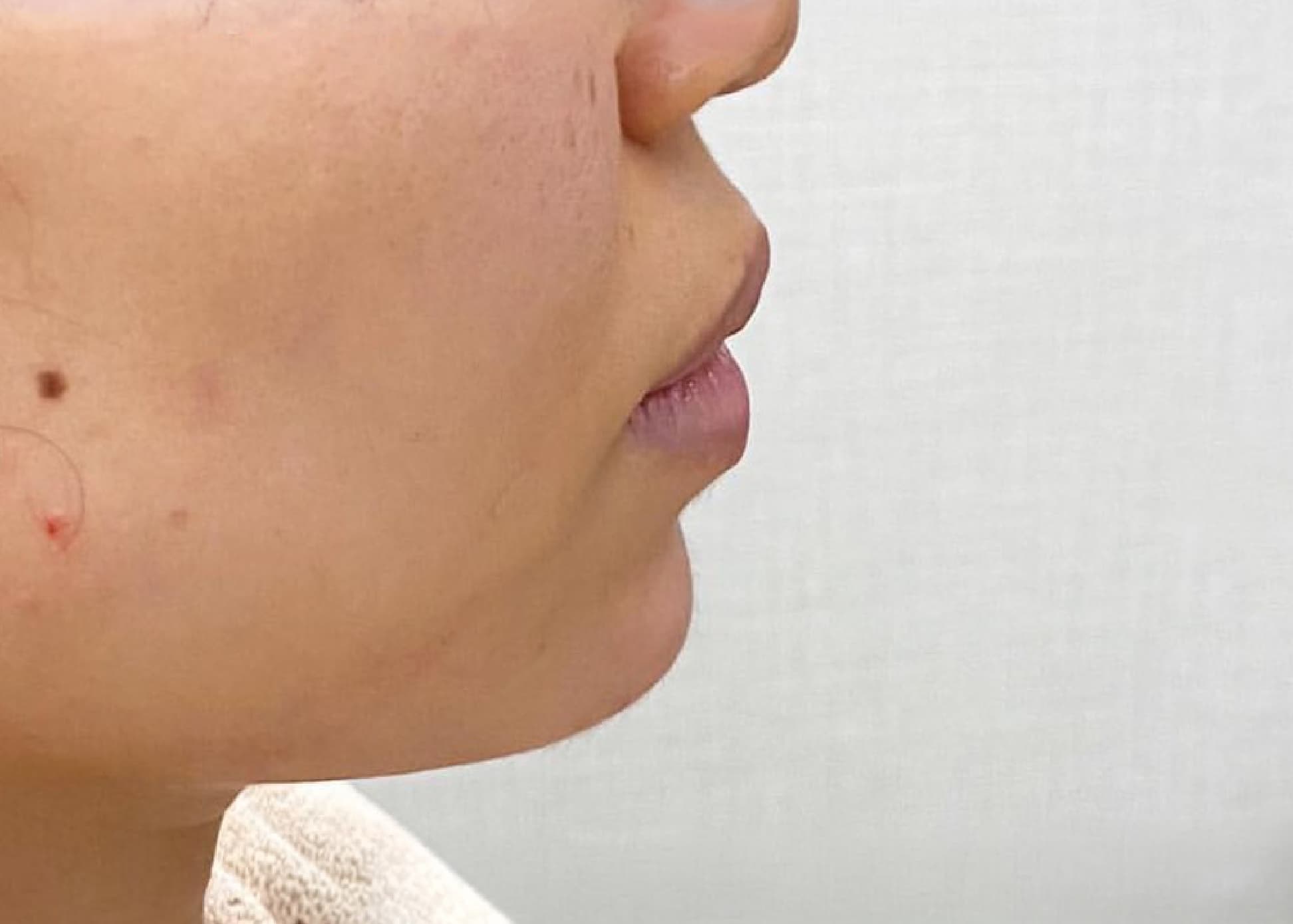 Philtrum Shortening Botox & Around Mouth Hyaluronic Acid Injection After