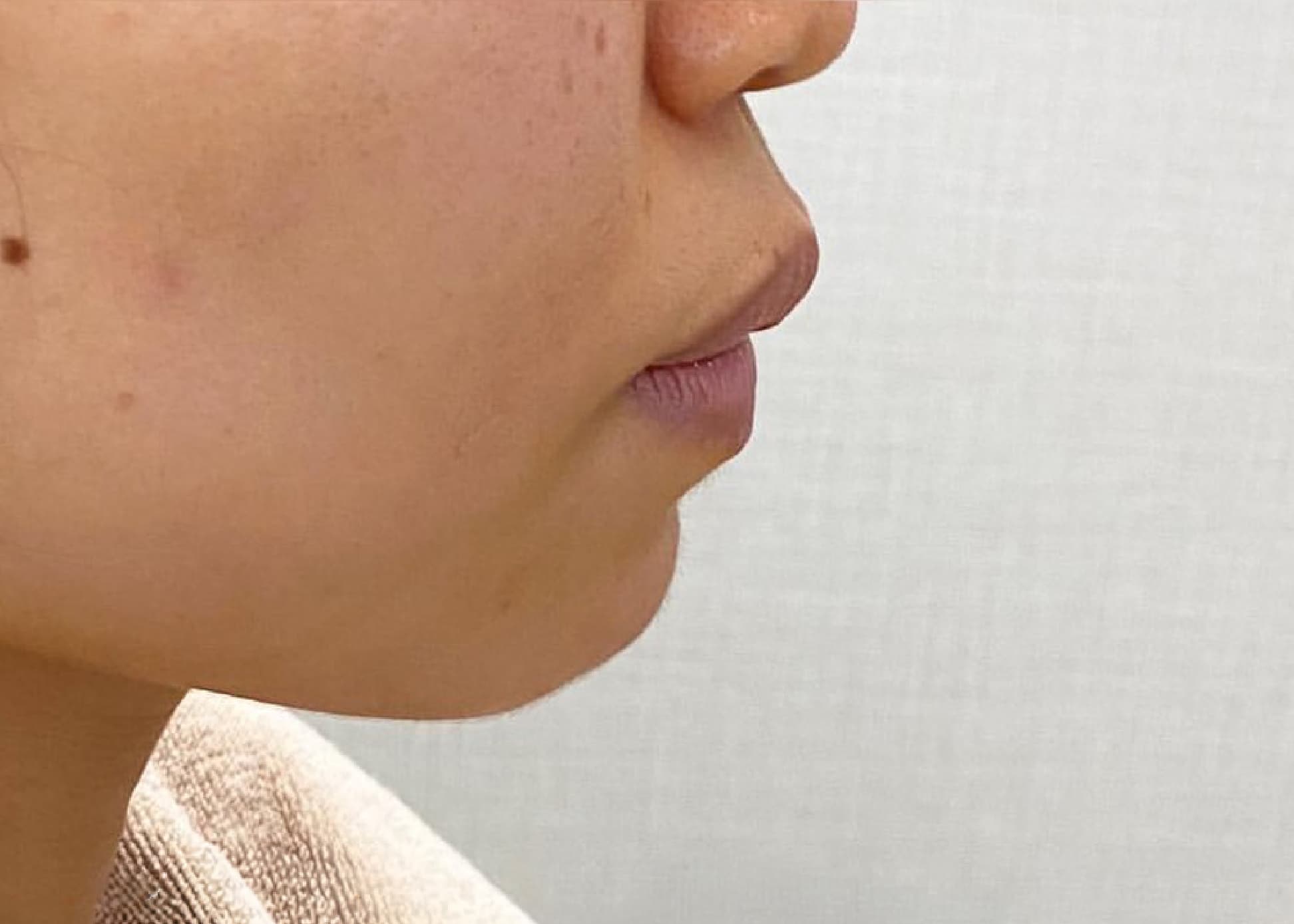 Philtrum Shortening Botox & Around Mouth Hyaluronic Acid Injection Before