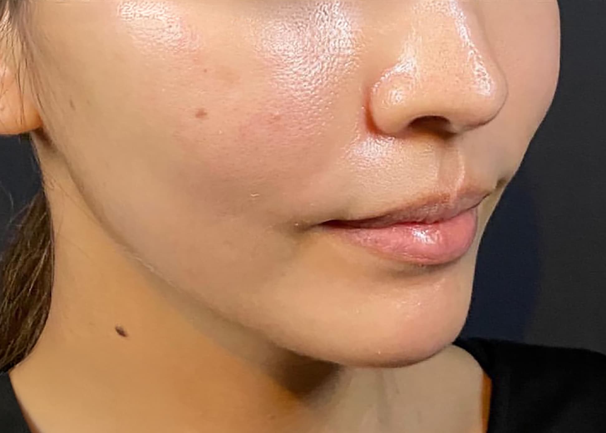 Mix Thread Lift After