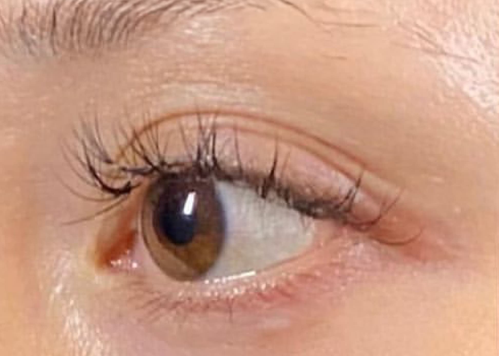 Upper Eyelid Hyaluronic Acid After