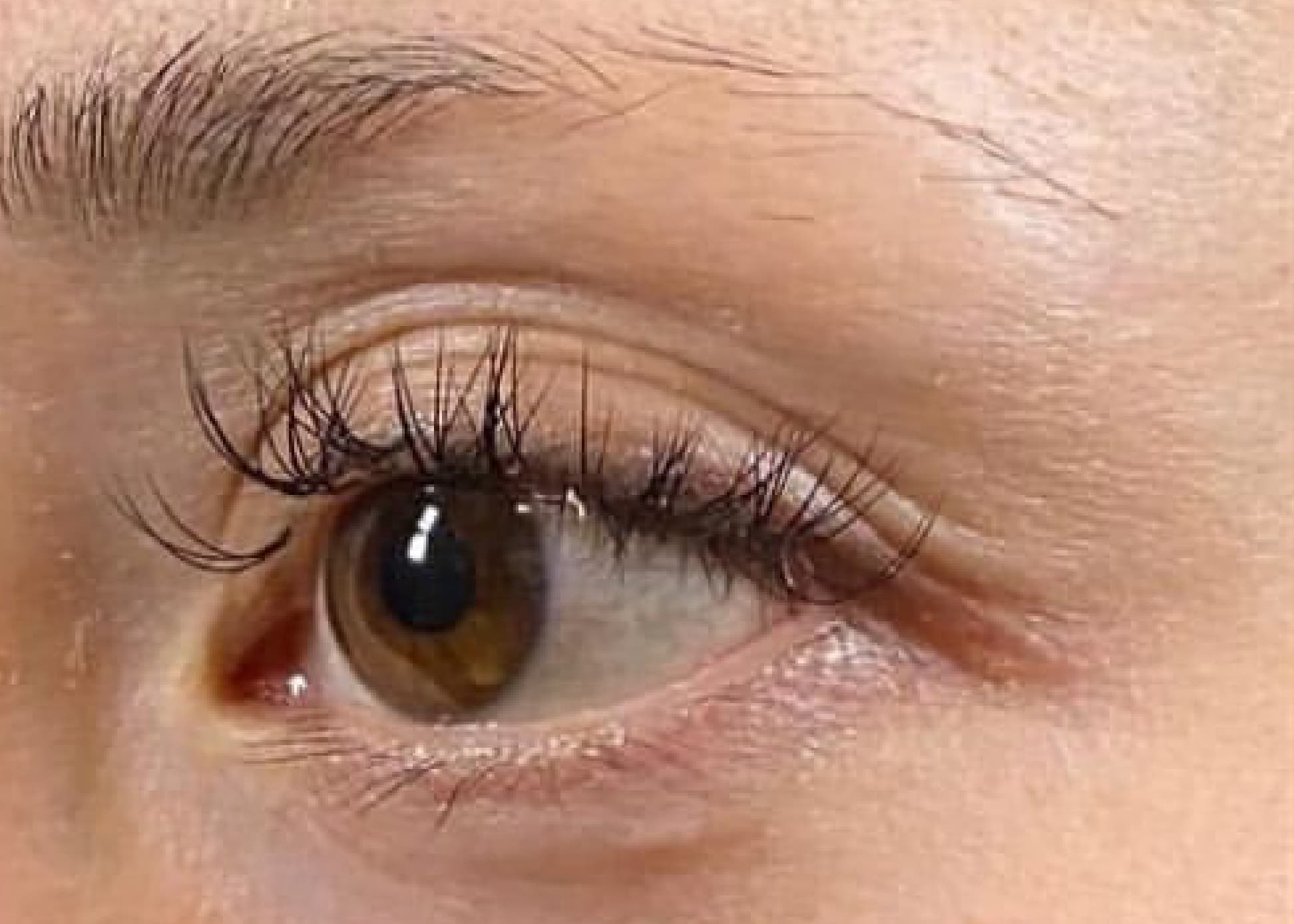 Upper Eyelid Hyaluronic Acid Before