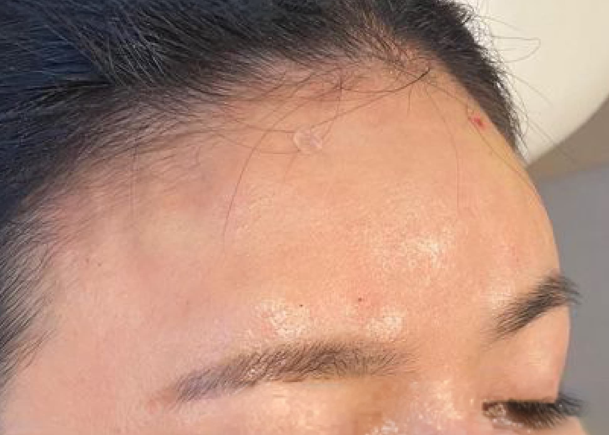 Forehead Hyaluronic Acid After