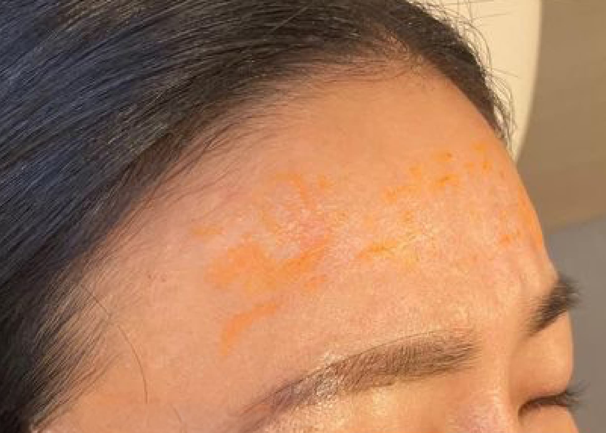 Forehead Hyaluronic Acid Before