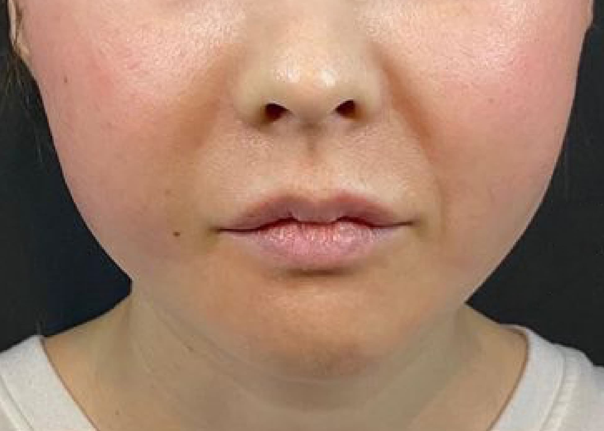 Thread Lift After
