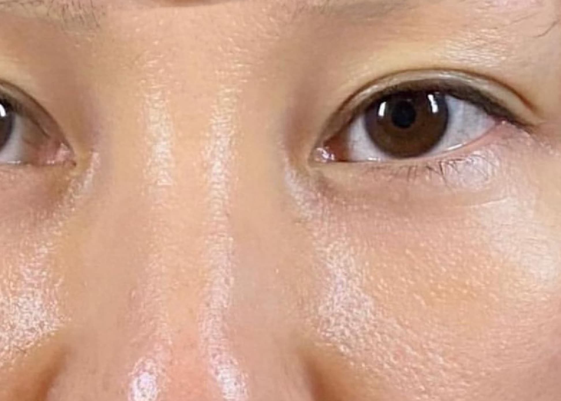 Lower Eyelid Fat Removal Surgery After
