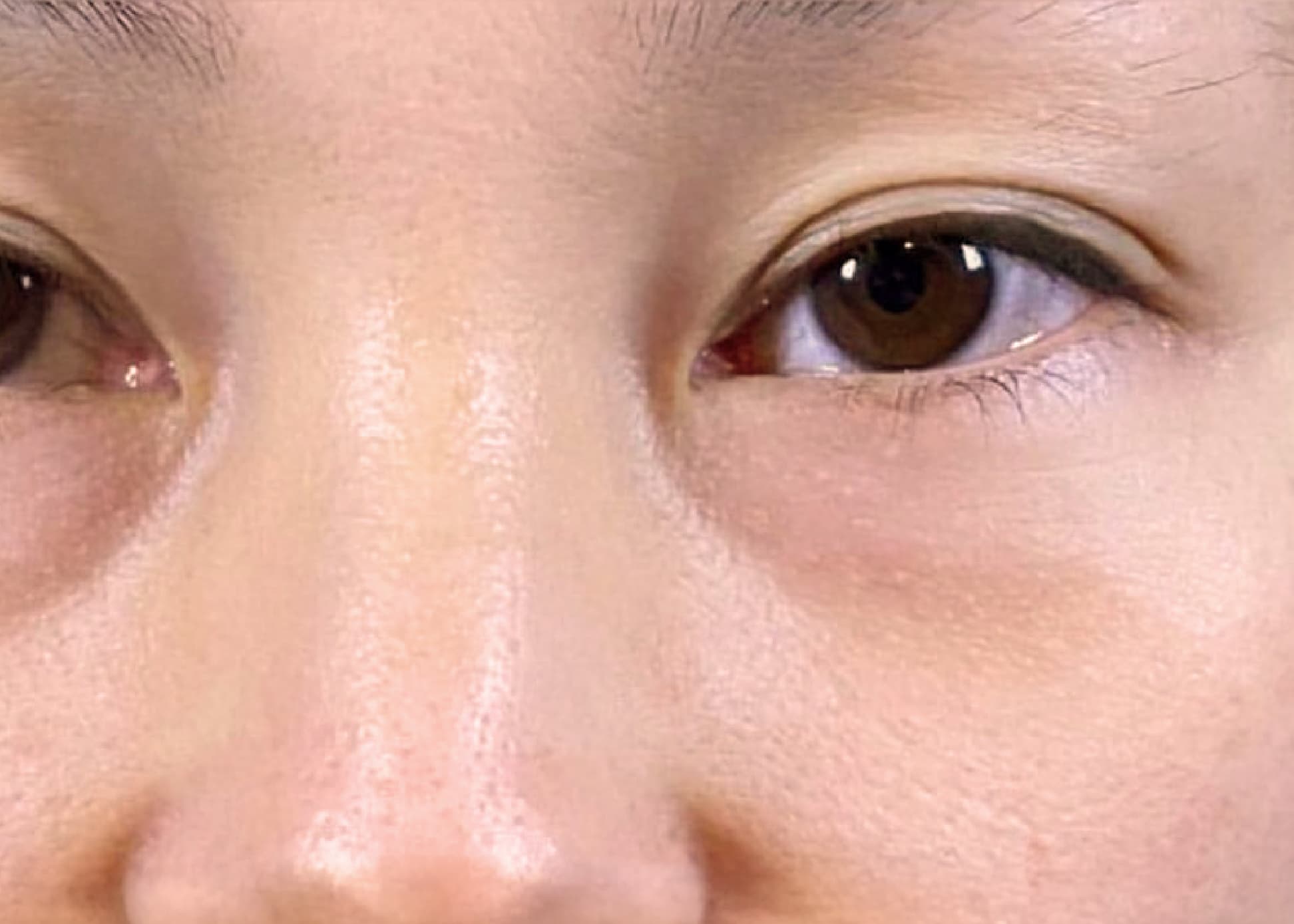 Lower Eyelid Fat Removal Surgery Before