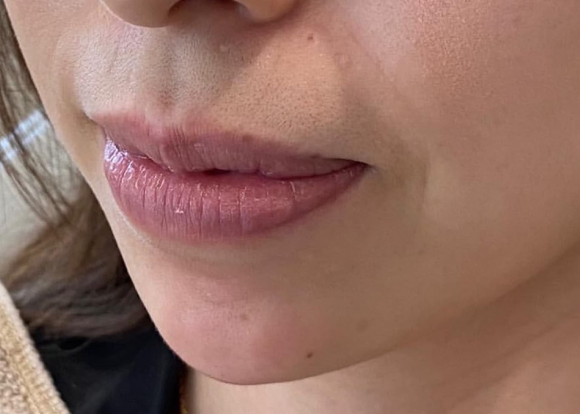 Chin Botox + Chin Filler After