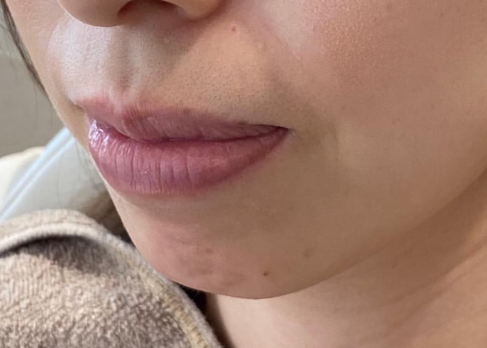 Chin Botox + Chin Filler Before