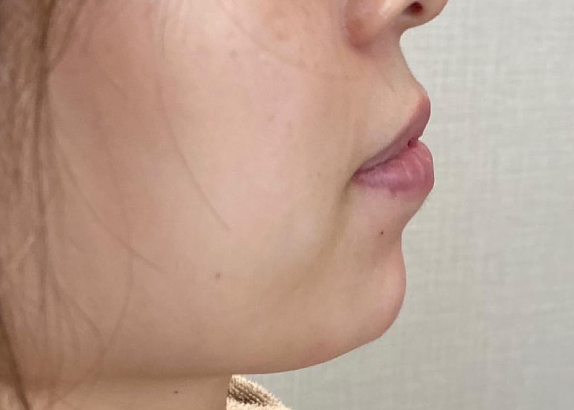 Chin Botox + Chin Filler After