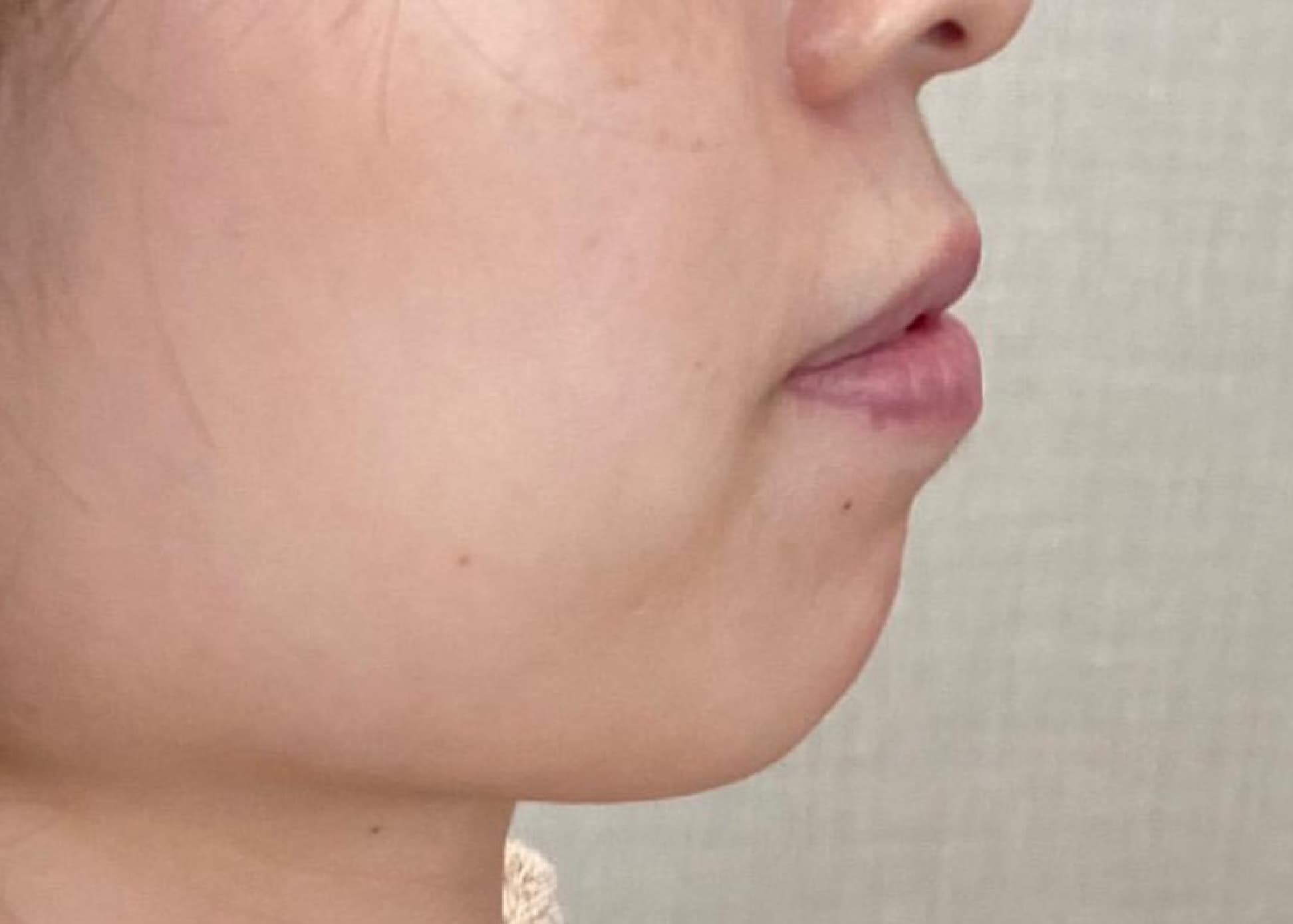 Chin Botox + Chin Filler Before