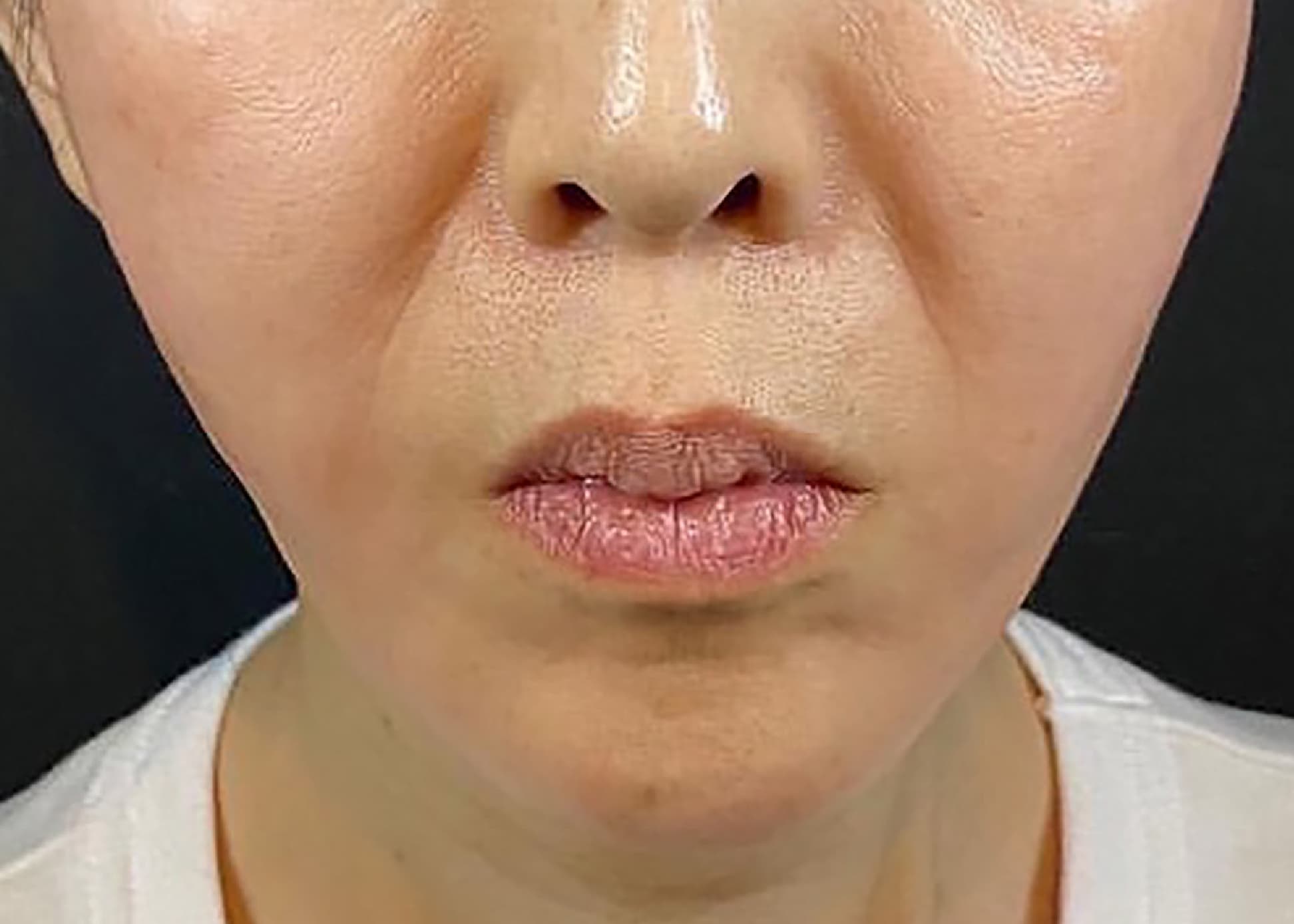 Thermagen+Thread Lift After
