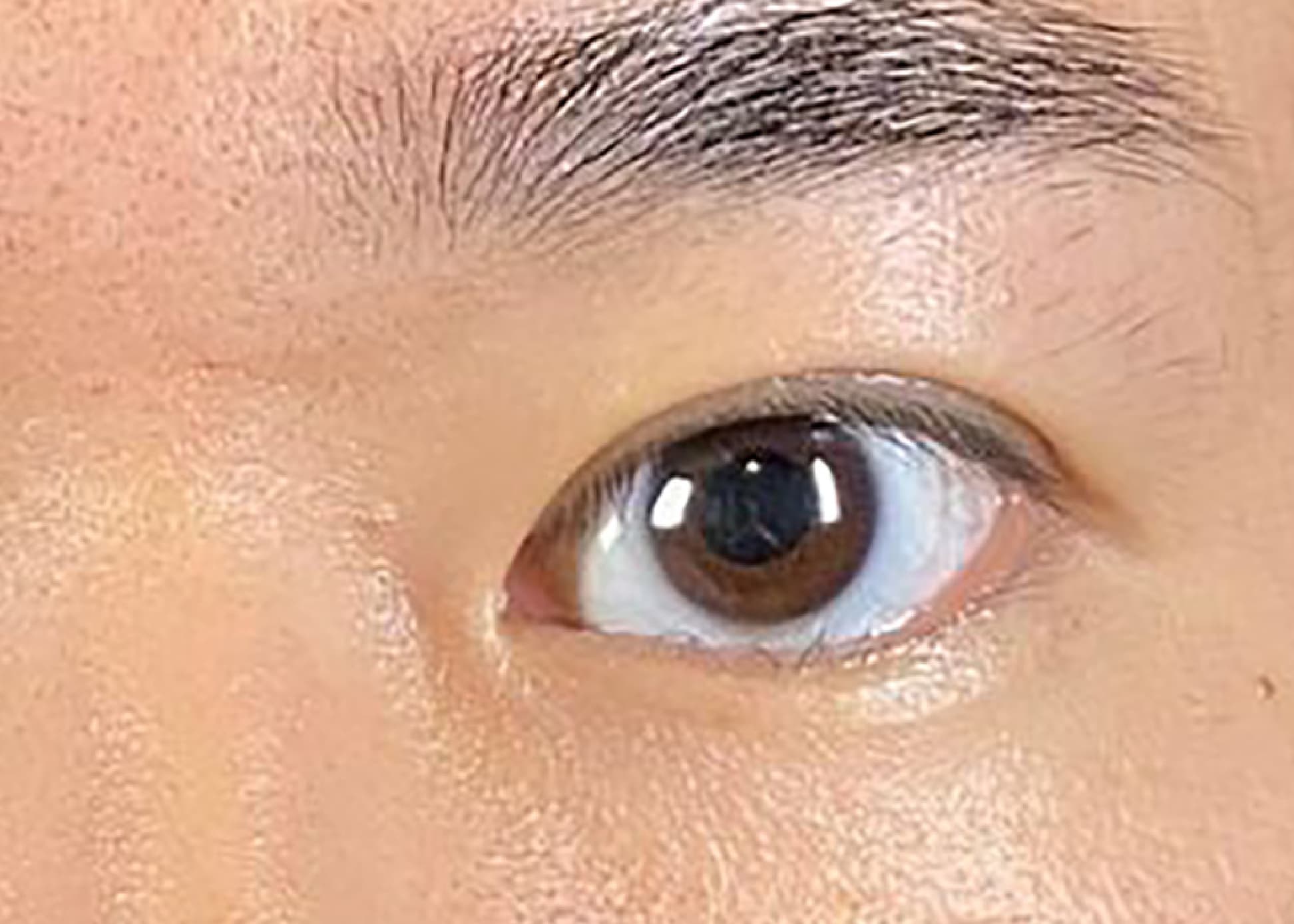 Non-incision Double Eyelid After