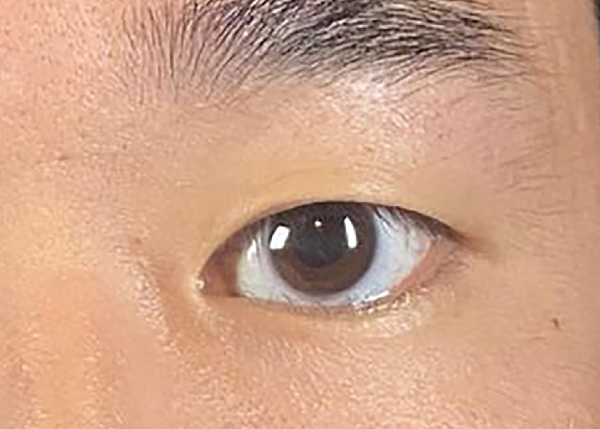 Non-incision Double Eyelid Before
