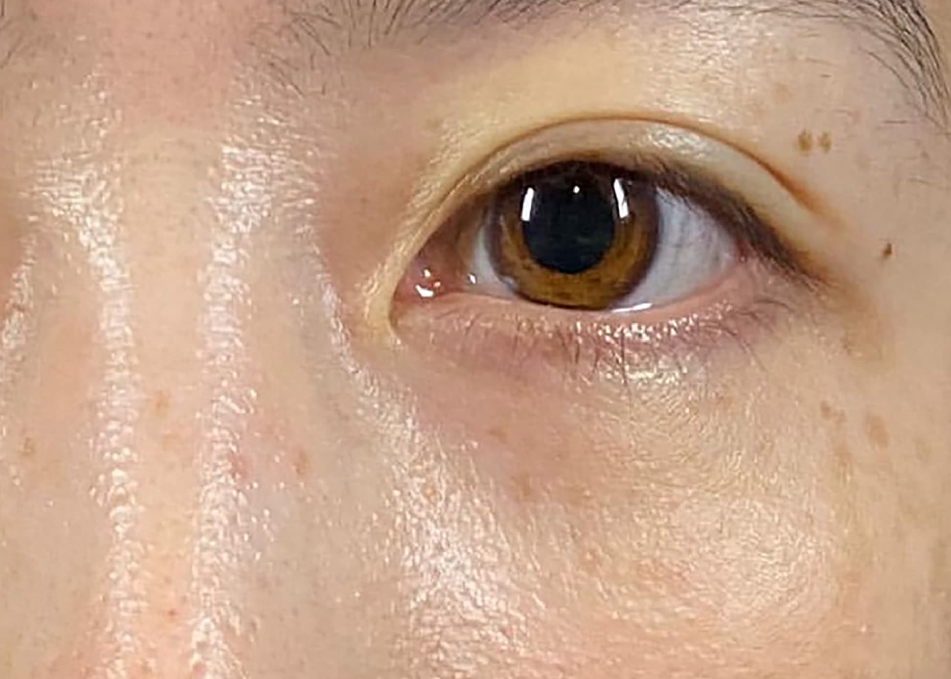 Lower Eyelid Fat Removal Surgery After
