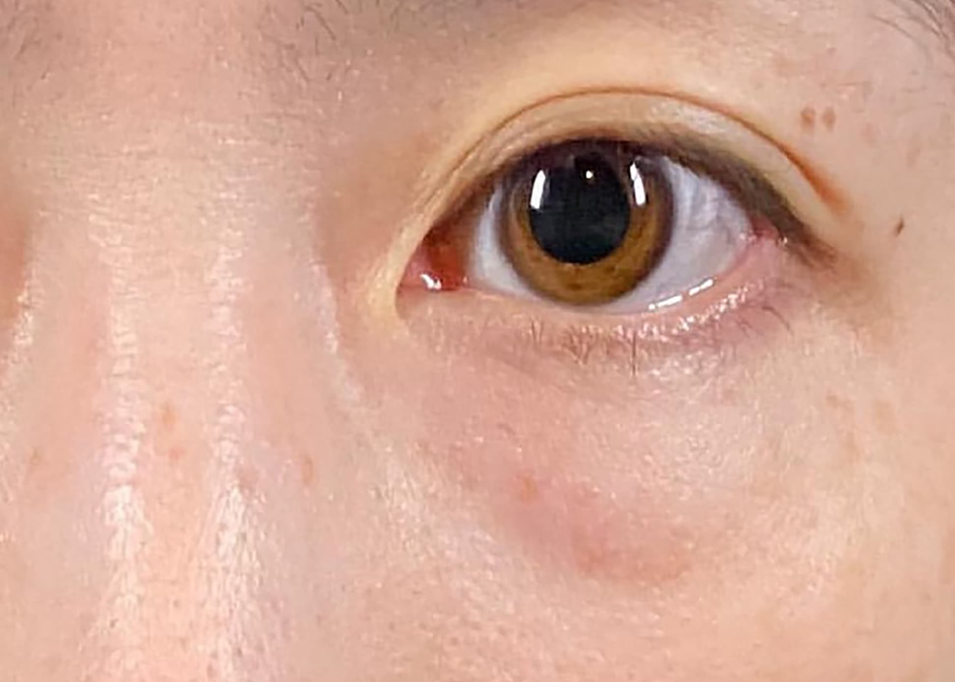 Lower Eyelid Fat Removal Surgery Before
