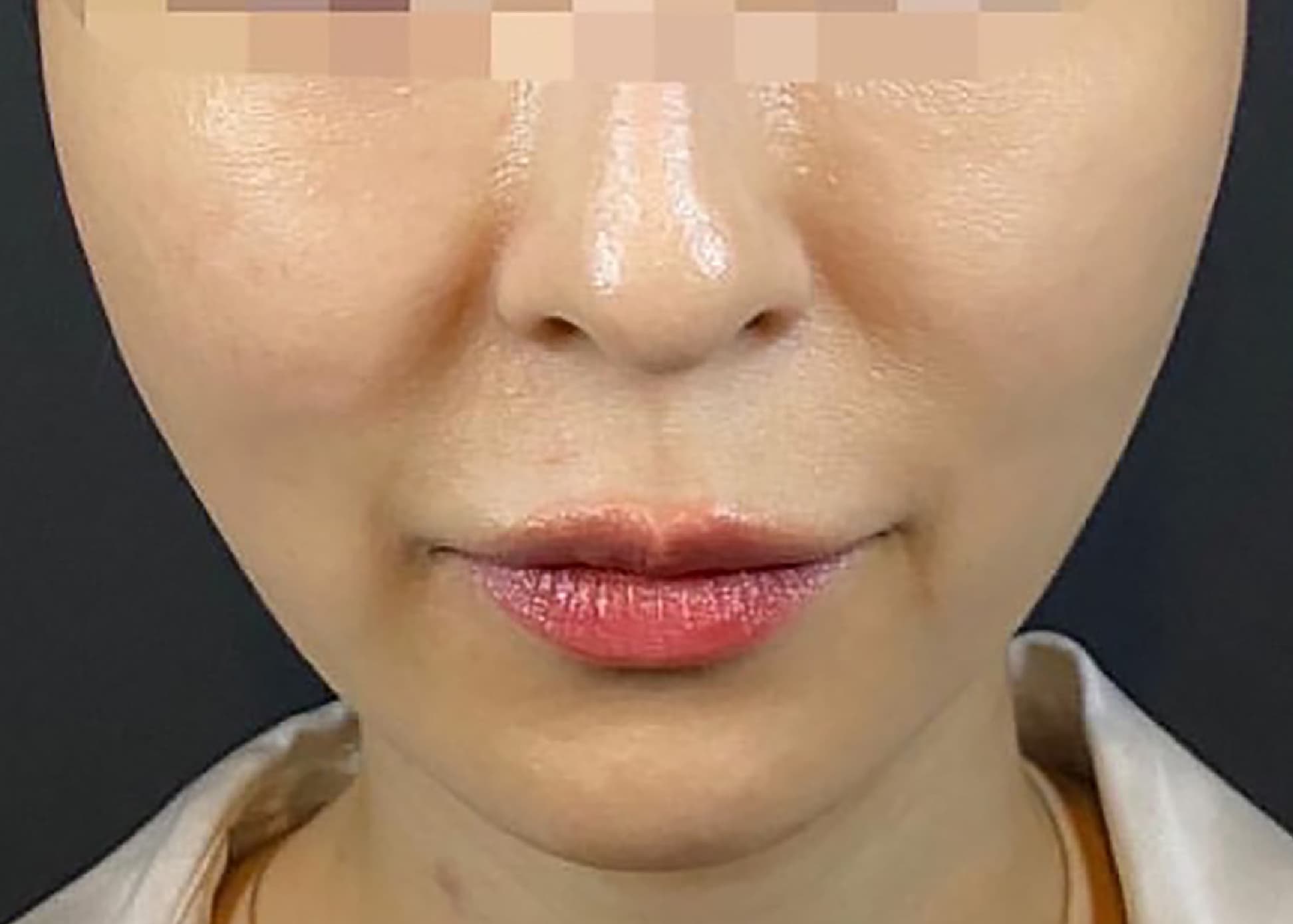Mix Thread Lift After