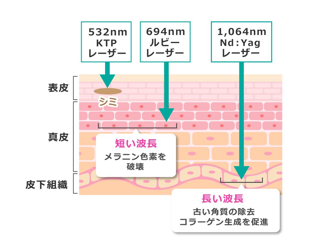 レーザーの種類の比較図