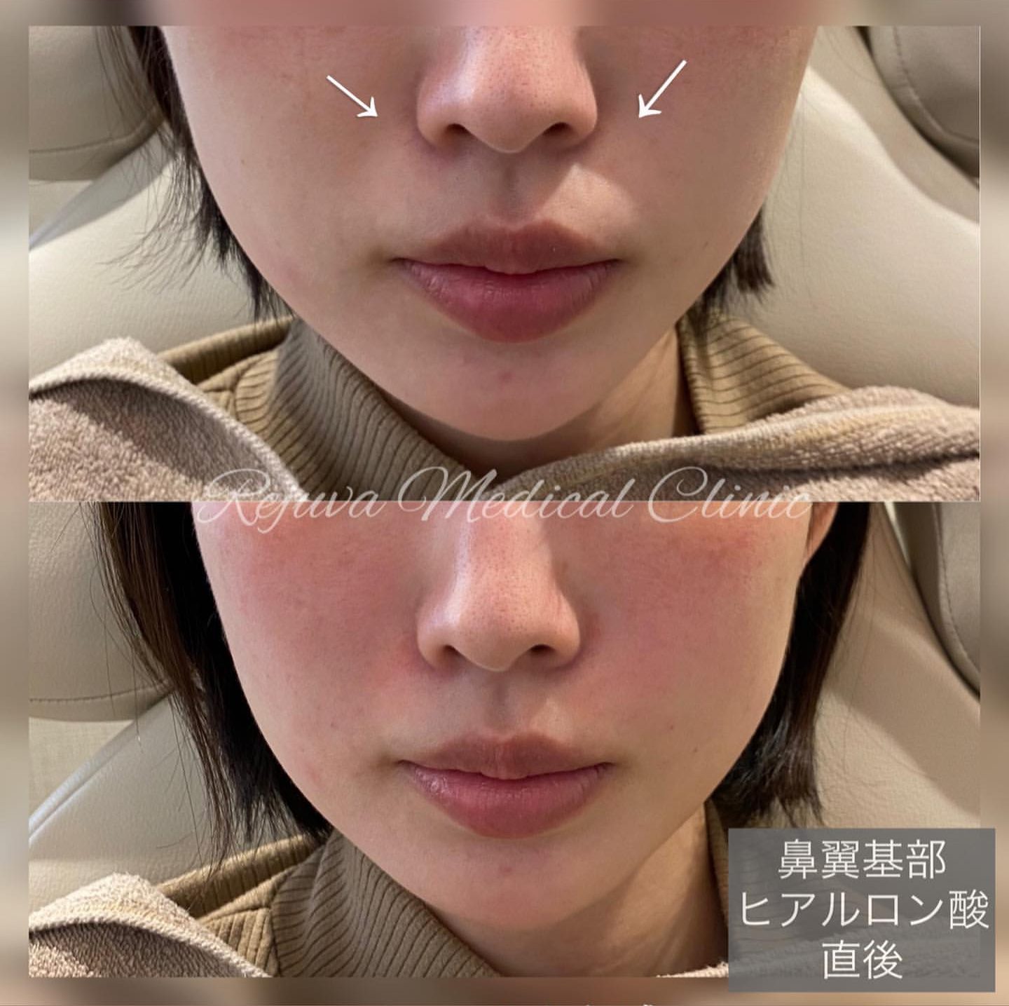 鼻翼 